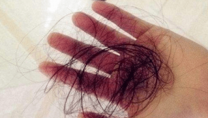 中国脱发人群已超2.5亿“秃然”的焦虑向年轻人发展