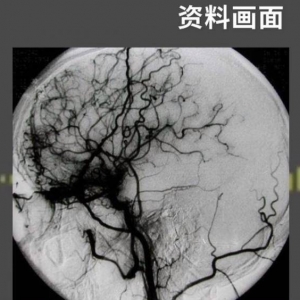 烟雾病！“18岁美女模特不喝水引发脑梗”冲上了热搜